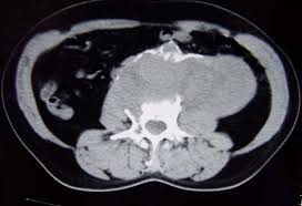 Um aneurisma de aorta abdominal (aaa) consiste de uma protuberância cheia de sangue em uma parte da aorta que passa pelo abdômen. Aneurisma Da Aorta Abdominal Roto Cronico Com Corrosao De Vertebra Lombar Download Scientific Diagram
