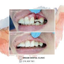 Frc Bridge Dream Dental Clinic Klinik Pergigian Dream Facebook