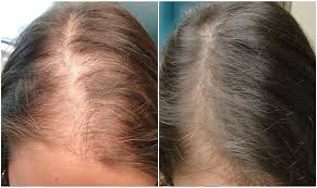 Platelets, which are found in your blood, are loaded with proteins called growth factors that accelerate wound healing. as it turns out, in high enough concentrations, growth factors are also. Prp Hair Loss Treatment Sheffield Medispa S10 Clinic