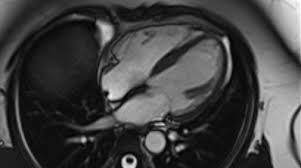 Image result for Cardiac MRI