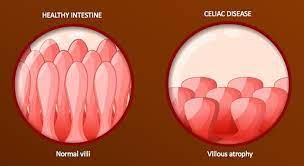The celiac disease foundation is the nation's leading. Gluten Testing Could Provide Insights On Celiac Disease Vector Blog