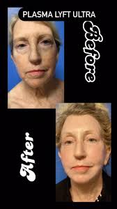 Another very natural but still stunning transformation with Dr. Lacerna's  Plasma LYFT Ultra, combining a deep plane face and Necklift, browlift,  blepharoplasties, fat grafting with PRP, NEOGEN plasma resurfacing, and  healing with