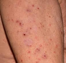 Image result for scabies human bites