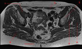Magnetic resonance imaging (mri) devices can provide direct transverse, sagittal, and coronal plane images. Mri Of The Hip Detailed Anatomy W Radiology