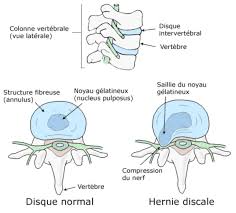 Issue de la partie haute du dos, cette névralgie apparaît comme l'un des problèmes de dos les plus répandus. Nevralgie Cervico Brachiale Chirurgie De La Colonne Vertebrale Beziers