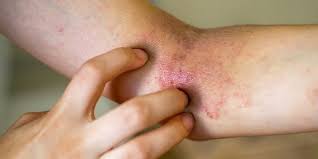 Image result for Eczema nummulare