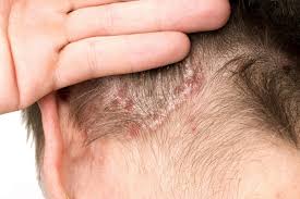 Intervista a sergio chimenti, professore ordinario di dermatologia e. Psoriasi Rimedi Naturali Lenire I Suoi Disturbi In Maniera Naturale