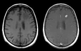 Some women have metastatic breast cancer when they are first diagnosed (called de novo metastatic breast brain metastasis: Metastatic Disease 2