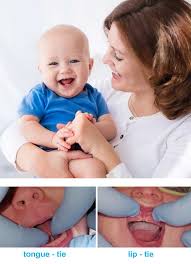 How do you know if your tongue is tied? Tongue Lip Tie Correction