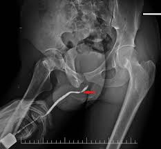 Image result for Retrograde Urethrogram