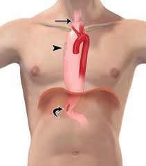 Minimally invasive esophagectomy (mie) was described in the 1990s in an effort to reduce operative morbidity. Esophagectomy And Gastric Pull Through Procedures Surgical Techniques Imaging Features And Potential Complications Radiographics