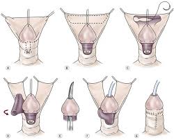 Image result for Chordee