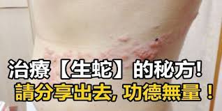 治療 生蛇 的秘方 超有效 請分享出去 功德無量 medical prescription health knowledge health remedies