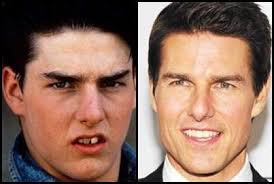 Tom cruise teeth is that post which describes the information on tom cruise tooth. Tom Cruise Teeth Implant Teeth Implants Dental Implants Teeth