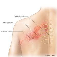 Image result for shingles in children