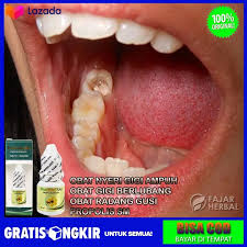 Sakit gigi berlubang dapat terasa sangat nyeri hingga menyebabkan anda tidak bisa makan, tidur obat ini dapat anda temukan dalam berbagai bentuk, seperti kapsul, tablet kunyah, obat tetes topikal. Obat Tetes Gigi Berlubang Obat Nyeri Gigi Obat Gusi Sering Bengkak Dan Bernanah Obat Pereda Nyeri Gigi Karena Ulam Pada Gigi Berlubang Obat Sakit Gigi Herbal Propolis Sm Lazada Indonesia