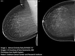 Breast screening aims to find breast cancers early. Your Patient Got A Dense Breast Notification With Her Mammogram Report What Are You Supposed To Do Christianacare News