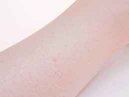 Prepare a warm (not hot) compress. How To Prevent Ingrown Hairs On Your Legs With Pictures