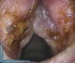 Image result for Reflux Laryngitis