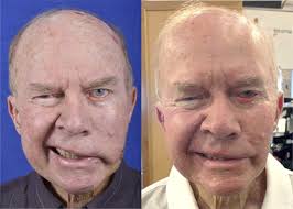 Contemporary techniques for nerve transfer in facial reanimation