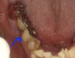 前装ブリッジについて | 名古屋市北区の歯医者｜おくい歯科へ