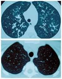 A quel âge s'achève l'enfance et commence la jeunesse ? La Mucoviscidose 1 Enfant Sur 2000 En Est Atteint