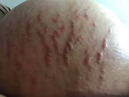 Crazy Itchy Stretch Marks August 2018 Babies Forums What To Expect