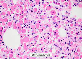Russell body (plural russell bodies). Webpathology Com A Collection Of Surgical Pathology Images