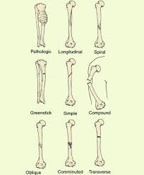 Finally, two days later, the other. Medical Doctors On Instagram Different Types Of Fractures Closed Fracture Open Fracture Transvers Types Of Fractures Comminuted Fracture Open Fracture