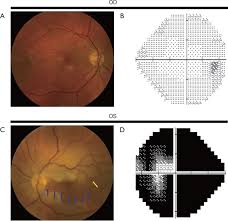 Beech 300/350 super king air. Left Central Retinal Artery Occlusion Crao With Sparing Of The Download Scientific Diagram