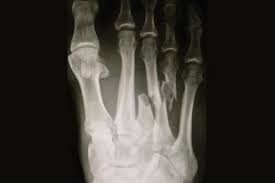 The third metatarsal bone is a long bone in the foot. The Lisfranc Tear Examining Kelly Slater S Extreme Foot Injury
