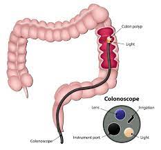 Feline cancer initially manifests as a lump or bump on any parts of the body. Colon Cancer Information Overview My Colon Cancer Coach