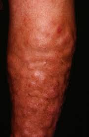 Rarely, people with graves' disease develop a reddish thickening of the skin on the shins, a condition called pretibial myxedema or graves' dermopathy. Graves Disease Amboss