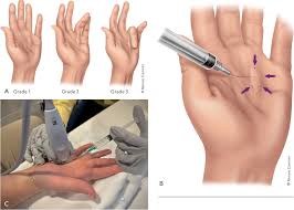 Image result for Hand Injection
