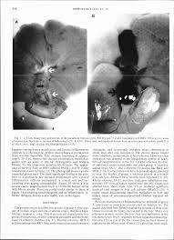 Image result for acholic stools human