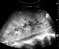Acute and chronic renal failure are the two kinds of kidney failure. Acute Kidney Injury Wikipedia