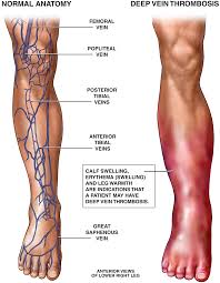 Deep Vein Thrombosis Healthdirect