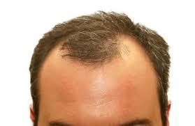 This type of hair loss is almost always caused by 'weave' and 'braid' types of hair styles. How Long Does It Take To Go Bald