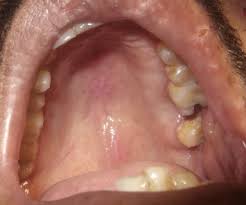 Image result for Oral herpes roof of mouth