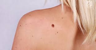Este gresit sa consideram imbatranirea pielii ca un eveniment biologic uniform, ci mai multe procese biologice. Melanomul Cel Mai Agresiv Cancer De Piele Pentru CÄƒ Metastazeaza Rapid Depistarea Precoce Este Vitala Laurusmedical Hemoroizi Varice Dermatologie Gastroenterologie