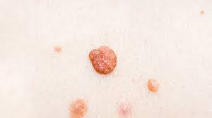 Anal Skin Tags: Symptoms, Causes, Recovery | Man Matters