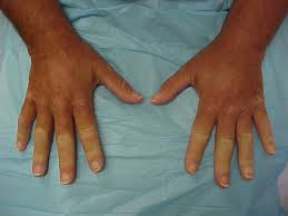 Image result for Scleroderma geaster