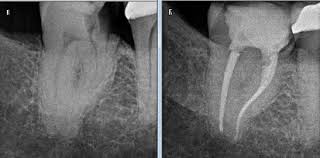 Root canal is basically a technique which is used to fix your infected, cracked, decayed or sometimes there is root canal needed after the crown. Do You Need A Dental Crown After Root Canal Bauer Smiles