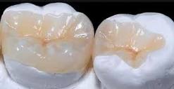Which causes more dental wear, the inlay or the resin if both ...