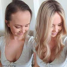 And while you may experience hair loss on your scalp, you may notice more hair elsewhere on the body, dr. Woman 33 Reveals How She Lost 70 Per Cent Of Her Hair After Switching Contraceptive Pill Daily Mail Online