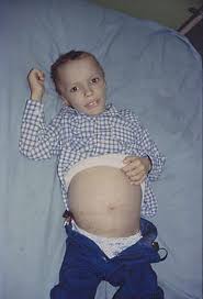 Lymphoma Images Hiv