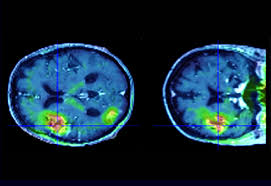 L'avc peut laisser d'importantes séquelles sur les personnes qui en ont souffert ou entraîner la mort dans bien des cas. Accident Vasculaire Cerebral Avc Inserm La Science Pour La Sante