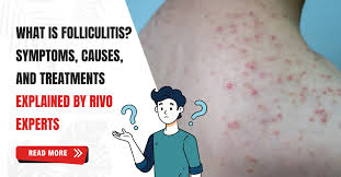 Image result for folliculitis symptoms