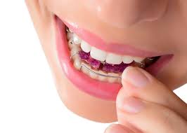 In general, overbites are caused by misalignment of the jaws and teeth in vertical and horizontal directions. Functional Teeth Braces Correct Overbite Orchard Orthodontics