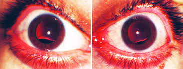 Image result for Coloboma